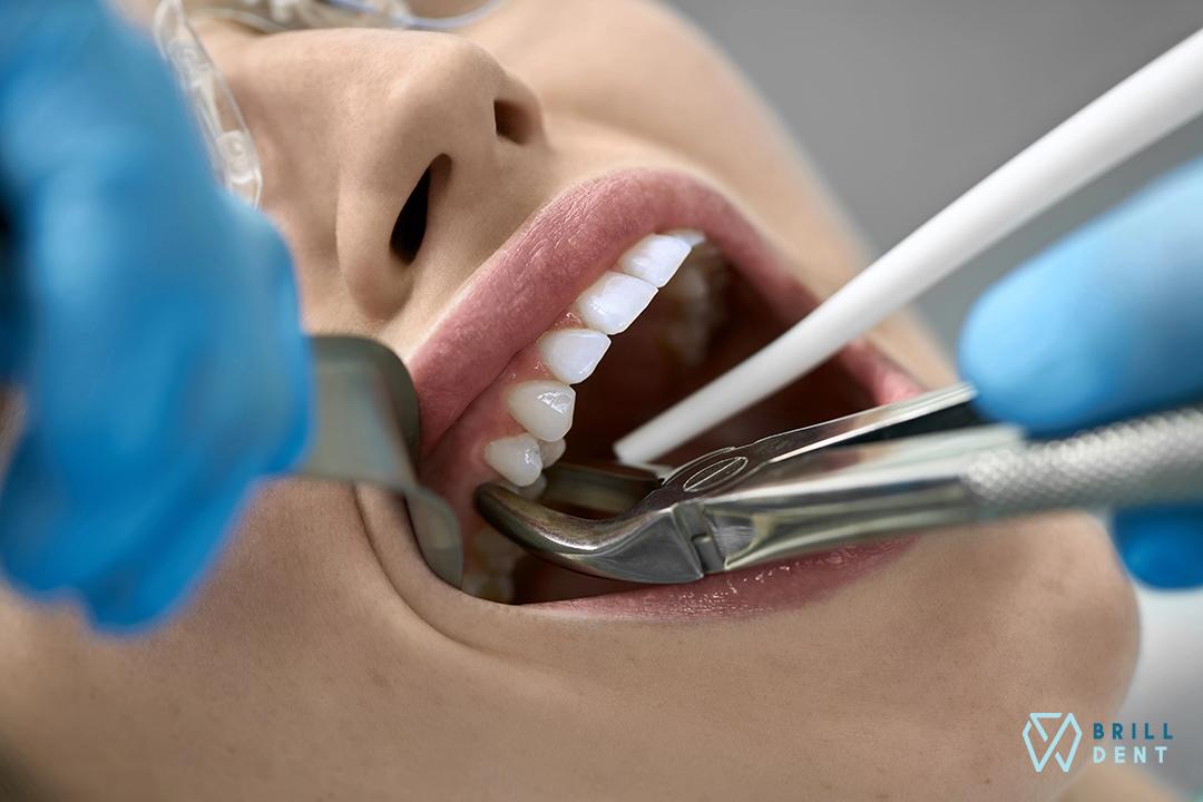 Ako sa starať o ranu po extrakcii zuba